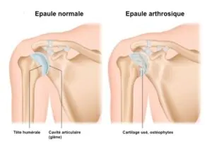 Arthrose de l'Épaule bayonne