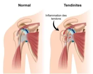 Pathologie du Long Biceps