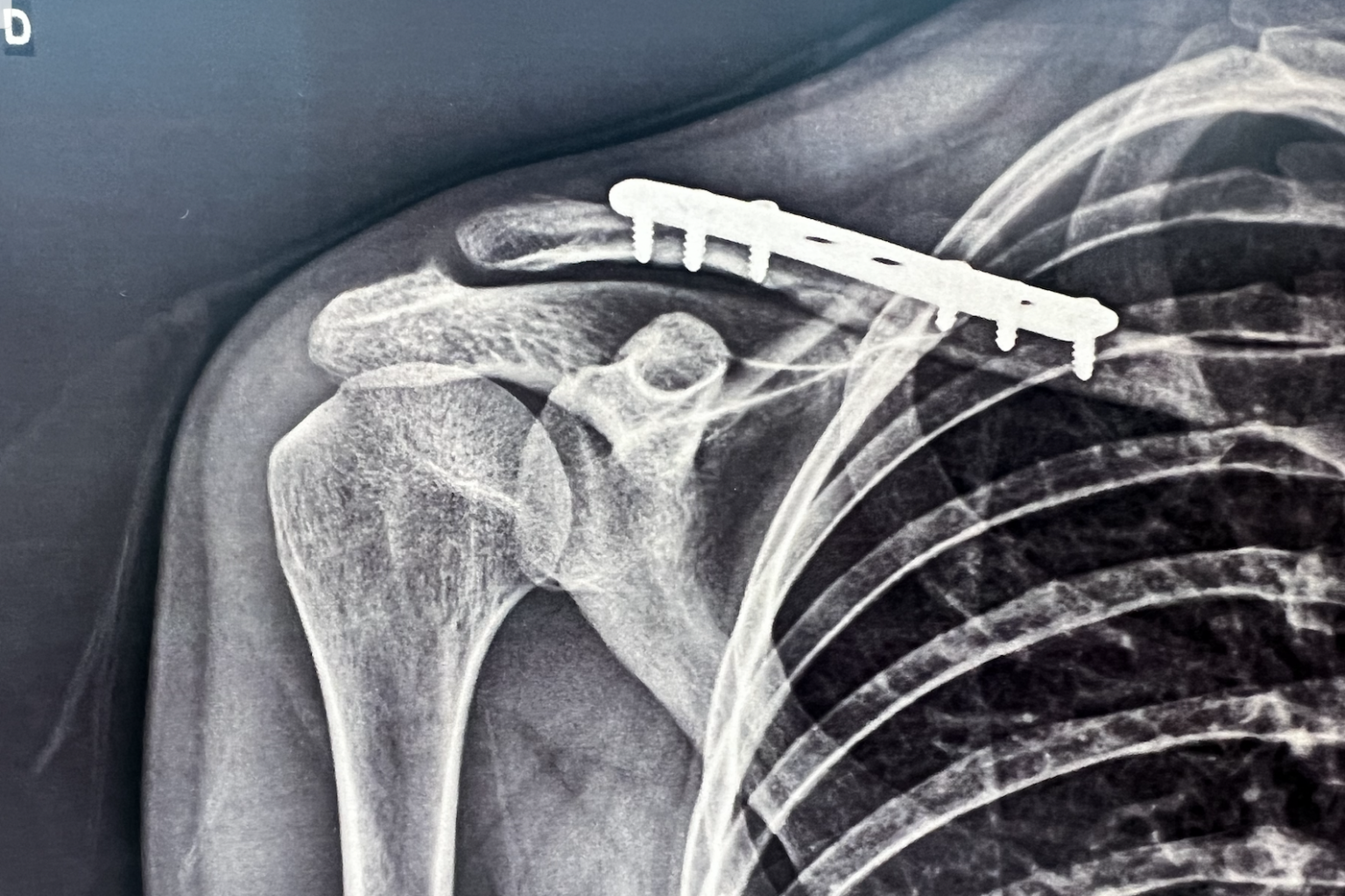 Les fractures de la clavicule symptômes et traitements — free download